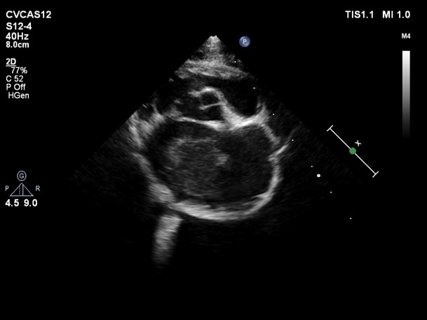 Clot in left atrium_Bill Tyrrell