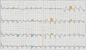 Example ECG/EKG