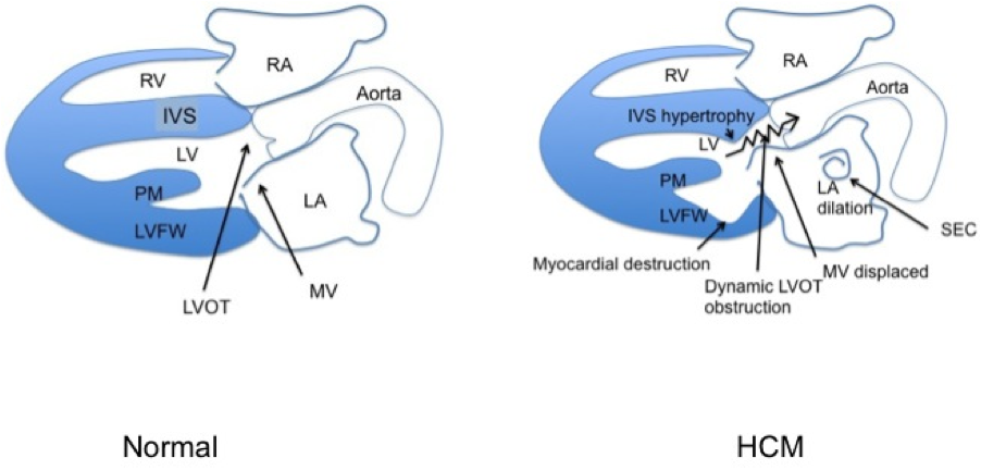 Figure 1: Features of hypertrophic cardiomyopathy (HCM) in cats.